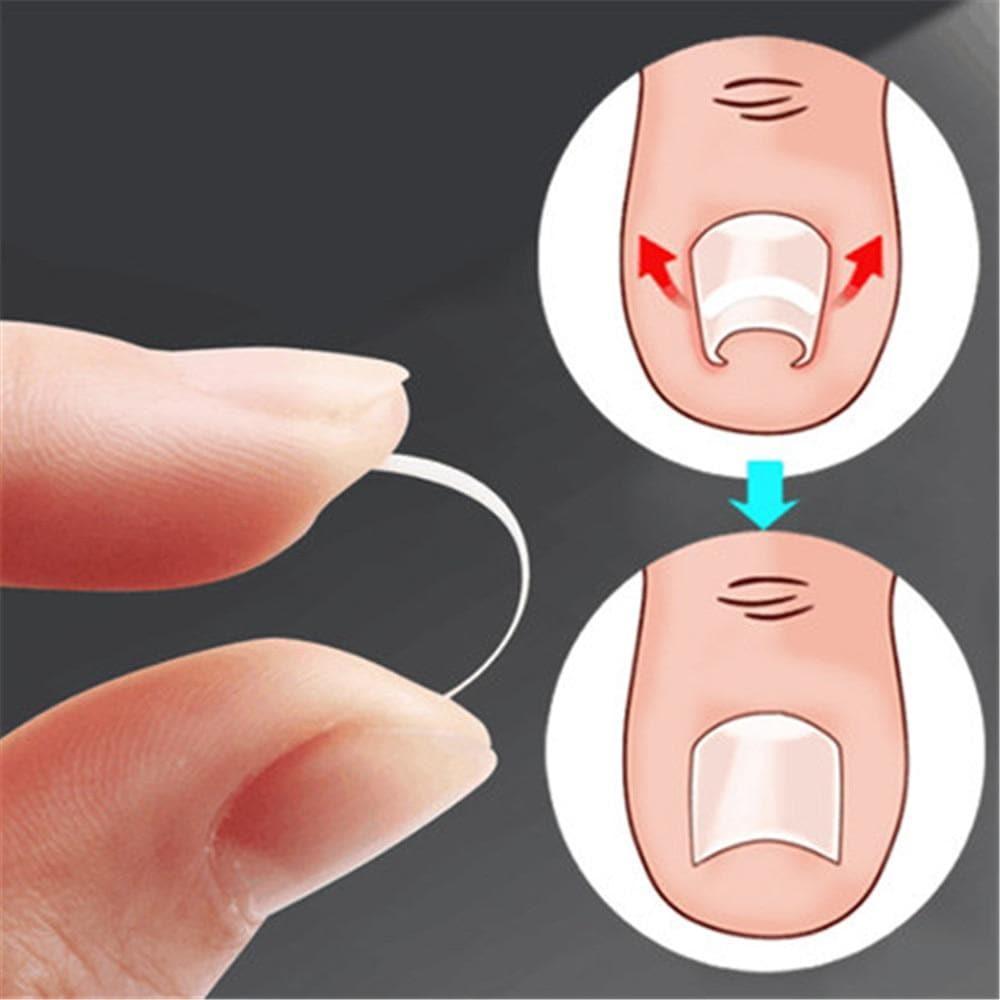 10pcs Ingrown Toenail Correction Patch Sticker - Ammpoure Wellbeing